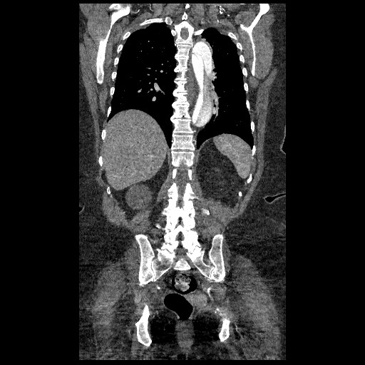 File:Aortic dissection - Stanford type B (Radiopaedia 88281-104910 B 63).jpg