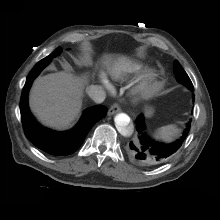 Aortic dissection with rupture into pericardium (Radiopaedia 12384-12647 A 45).jpg