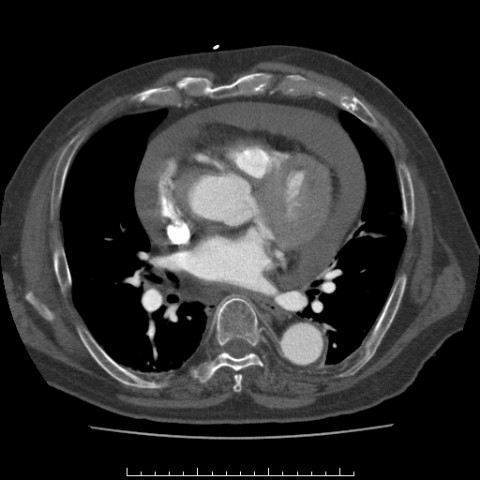 File:Aortic dissection with rupture into the pericardial sac (Radiopaedia 23726-23879 C+ arterial phase 5).jpg
