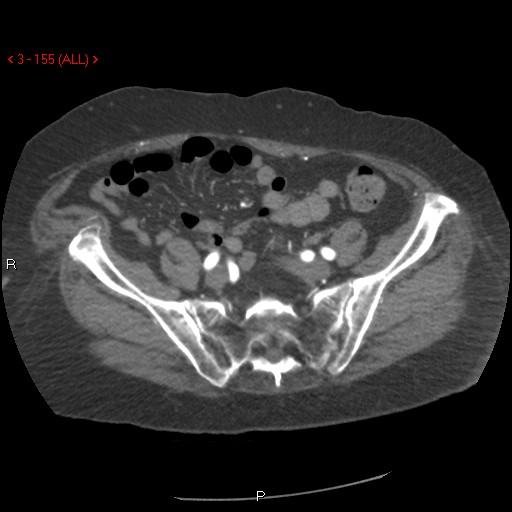 Aortic intramural hematoma (Radiopaedia 27746-28001 A 155).jpg