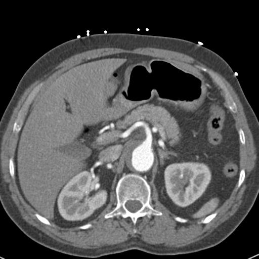 Aortic intramural hematoma (Radiopaedia 31139-31838 B 90).jpg
