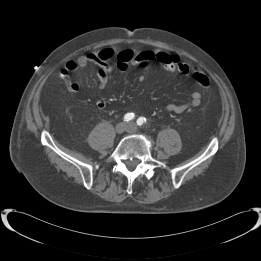 Aortic intramural hematoma (Radiopaedia 34260-35540 B 69).png