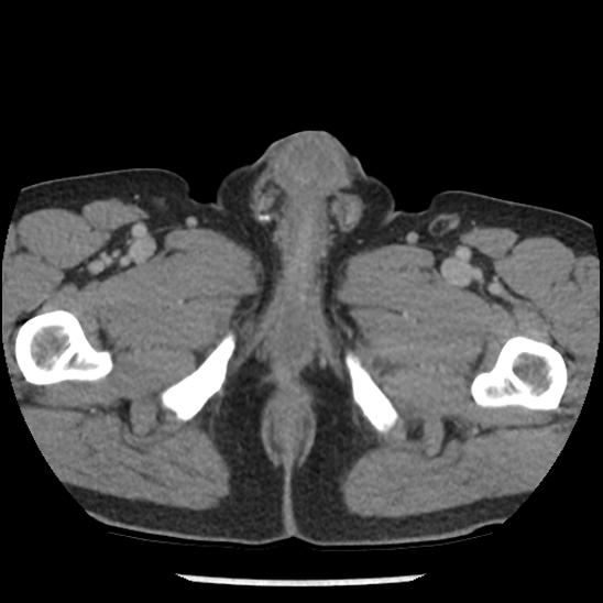 Aortic intramural hematoma (type B) (Radiopaedia 79323-92387 Axial C+ delayed 125).jpg