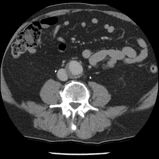 File:Aortic intramural hematoma (type B) (Radiopaedia 79323-92387 Axial C+ delayed 80).jpg