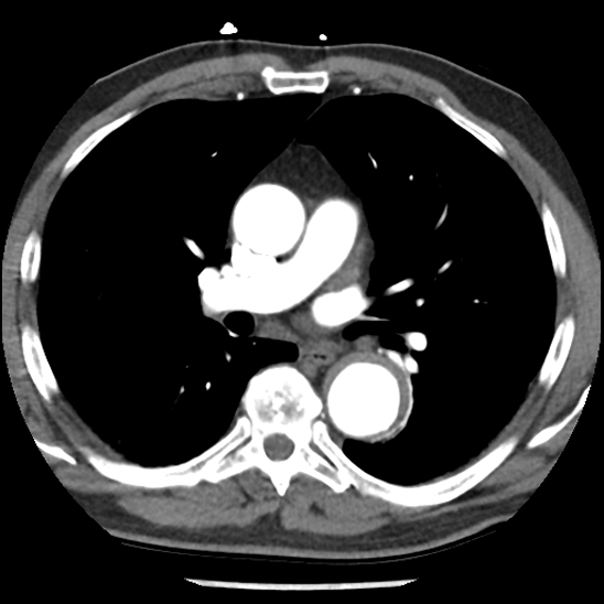 Aortic intramural hematoma (type B) (Radiopaedia 79323-92387 B 25).jpg