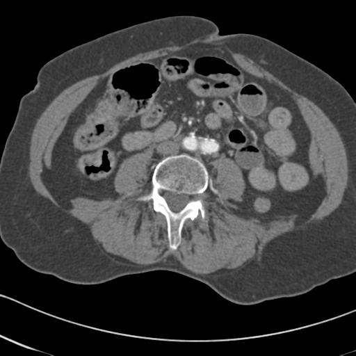 Aortic intramural hematoma from penetrating atherosclerotic ulcer (Radiopaedia 31137-31836 A 121).jpg