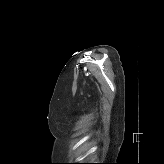 Aortic intramural hematoma with dissection and intramural blood pool (Radiopaedia 77373-89491 D 1).jpg