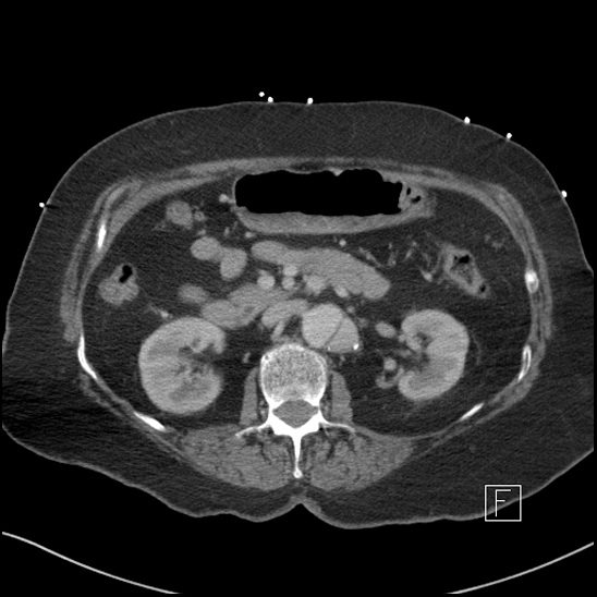 Aortic intramural hematoma with dissection and intramural blood pool (Radiopaedia 77373-89491 E 27).jpg