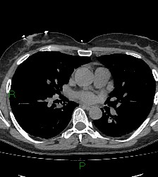 Aortic valve endocarditis (Radiopaedia 87209-103485 Axial non-contrast 53).jpg