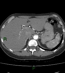 Aortic valve endocarditis (Radiopaedia 87209-103485 C 94).jpg