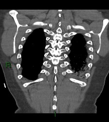 Aortic valve endocarditis (Radiopaedia 87209-103485 D 11).jpg