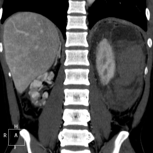 File:Aorto-left renal vein fistula (Radiopaedia 45534-49628 B 50).jpg