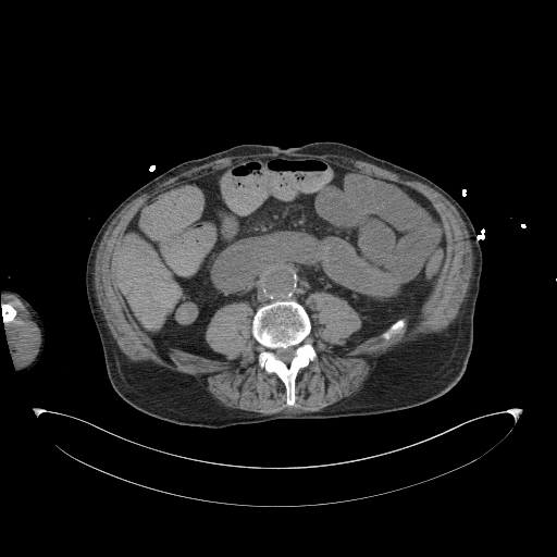 Aortoduodenal fistula (Radiopaedia 75286-86415 Axial non-contrast 40).jpg