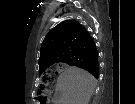 Aortoesophageal fistula with endovascular repair (Radiopaedia 73781-84592 Sagittal C+ CTPA 39).jpg