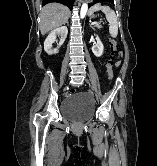 Aortoiliac occlusive disease (Radiopaedia 52352-58248 B 37).jpg