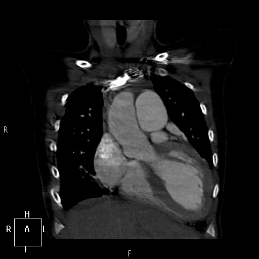 File:Aortopulmonary septal defect (Radiopaedia 41990-45013 Coronal C+ CTPA 13).jpg