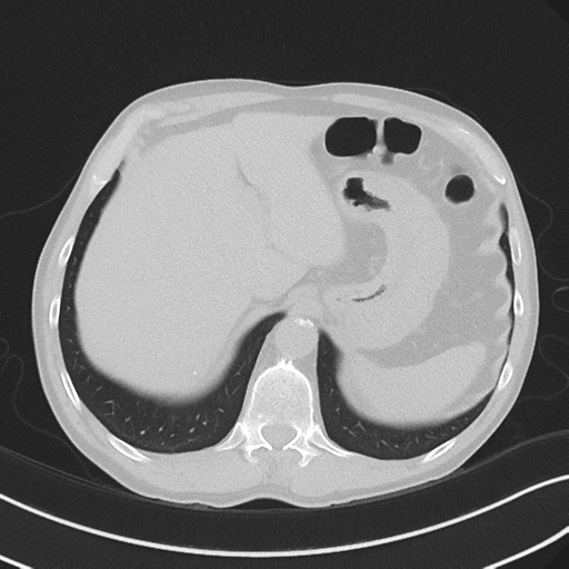 Apical pulmonary metastasis (Radiopaedia 46338-50754 Axial non-contrast 57).png