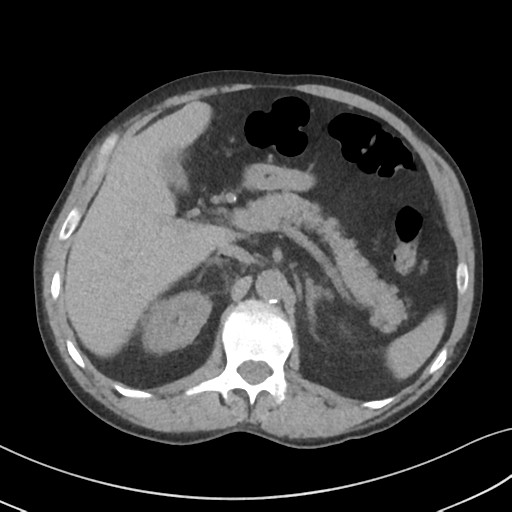 Apical pulmonary metastasis (Radiopaedia 46338-50754 B 65).png