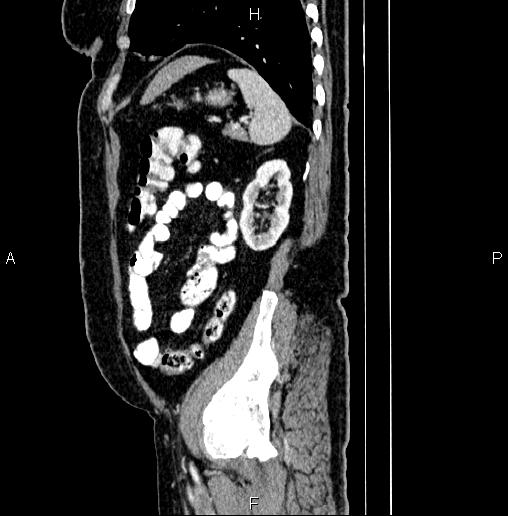 File:Appendiceal mucocele (Radiopaedia 82952-97298 D 88).jpg