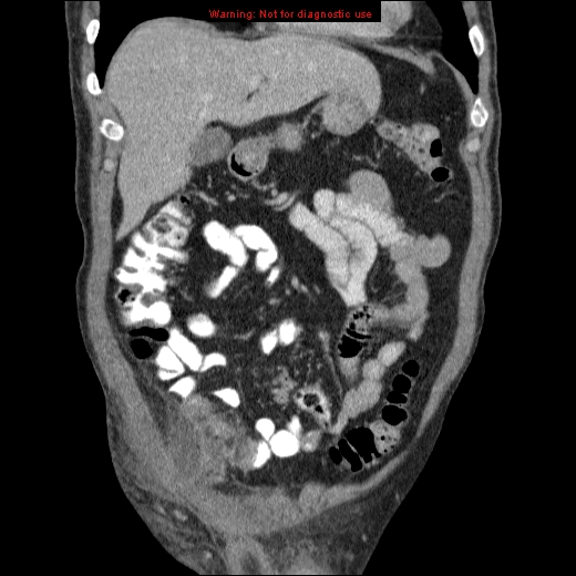 File:Appendicitis mass in inguinal hernia (Radiopaedia 26858-27029 B 19).jpg