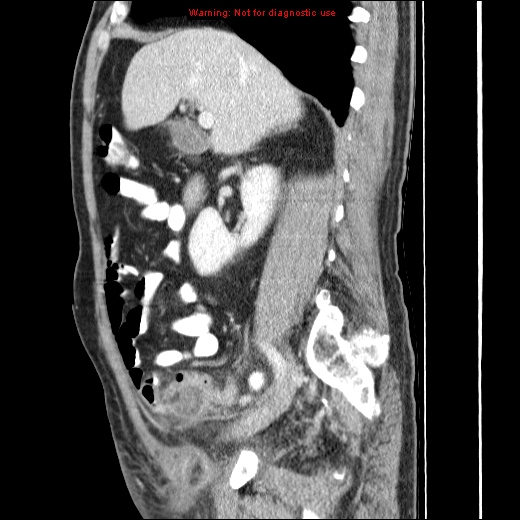 File:Appendicitis mass in inguinal hernia (Radiopaedia 26858-27029 C 19).jpg
