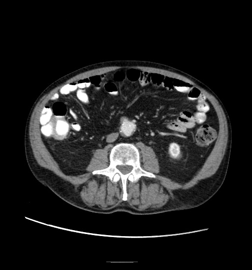 File:Appendicitis with localized perforation and abscess formation (Radiopaedia 49035-54130 A 50).jpg