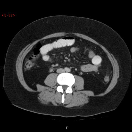 File:Appendicitis with microperforation- promontoric type (Radiopaedia 27268-27442 C 40).jpg
