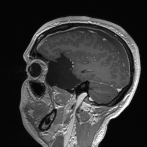 Arachnoid cyst with subdural hematoma (Radiopaedia 85892-101743 Sagittal T1 C+ 29).png