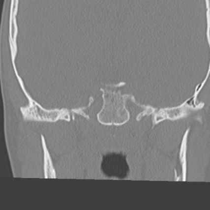 File:Arrested pneumatization of the sphenoid (Radiopaedia 10700-11172 Coronal non-contrast 13).jpg