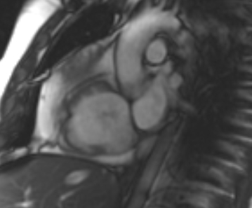 Arrhythmogenic right ventricular cardiomyopathy (Radiopaedia 69431-79307 Short axis cine 225).jpg