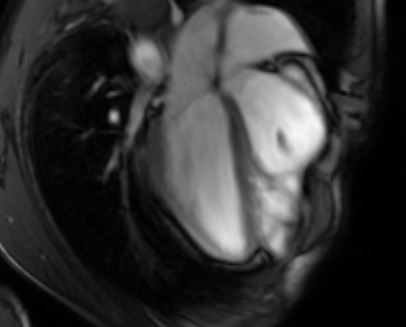 Arrhythmogenic right ventricular cardiomyopathy (Radiopaedia 69564-79464 4ch cine 65).jpg