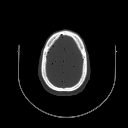 Arrow injury to the brain (Radiopaedia 72101-82607 Axial bone window 87).jpg