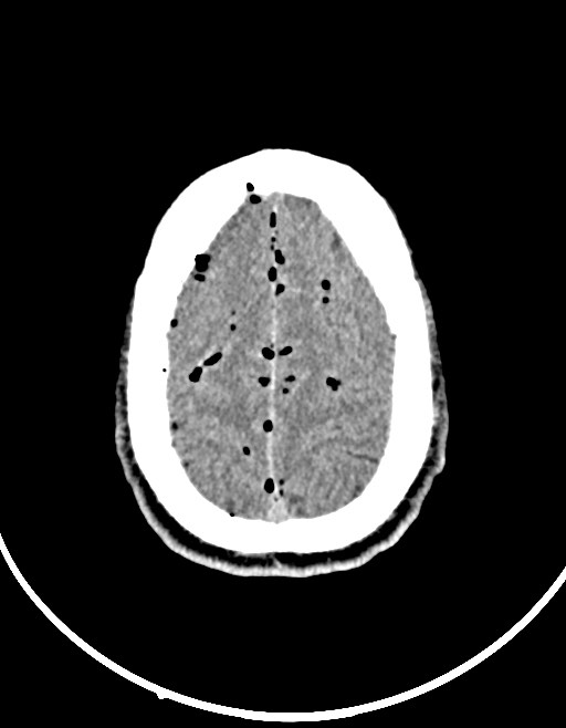 Arrow injury to the brain (Radiopaedia 72101-82607 Axial non-contrast 87).jpg