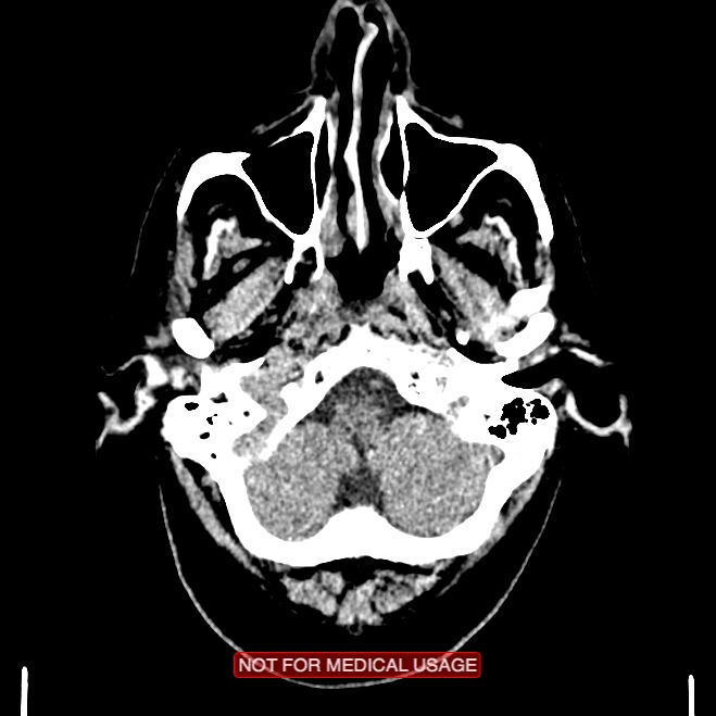 Artery of Percheron infarction (Radiopaedia 28679-28967 Axial non-contrast 15).jpg
