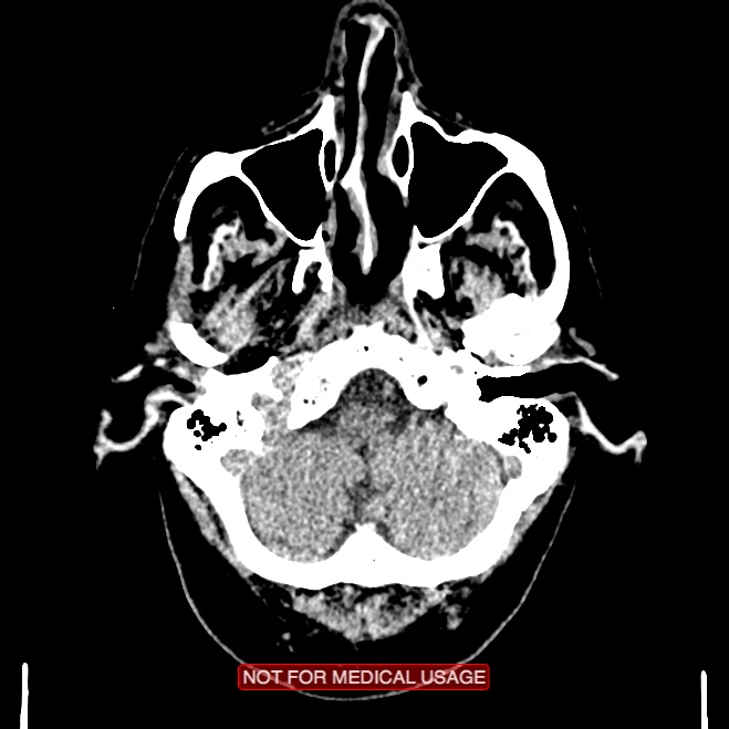 Artery of Percheron infarction (Radiopaedia 28679-28967 Axial non-contrast 18).jpg