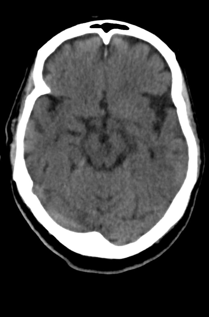 Artery of Percheron infarction (Radiopaedia 80613-94202 Axial non-contrast 78).jpg