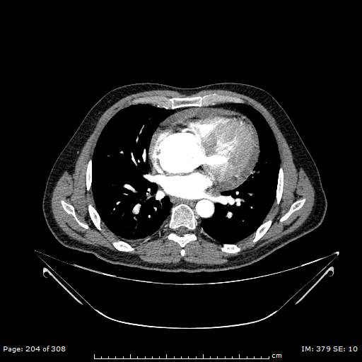 Ascending aortic aneurysm (Radiopaedia 50086-55404 A 54).jpg