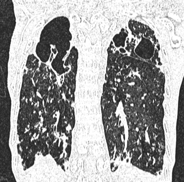 Aspergilloma- with Monod sign (Radiopaedia 44737-48532 Coronal lung window 339).jpg
