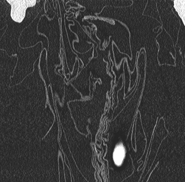 Aspergilloma- with Monod sign (Radiopaedia 44737-48532 Coronal lung window 95).jpg