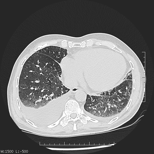 Aspergilloma (Radiopaedia 75184-86270 Axial lung window 40).jpg