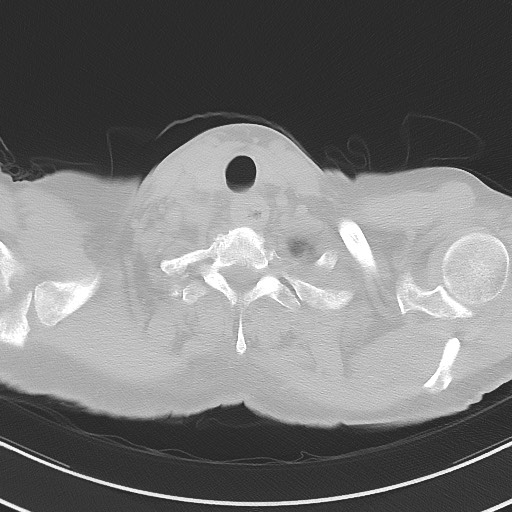 Aspergilloma on background pulmonary fibrosis (Radiopaedia 60942-68757 A 2).jpg