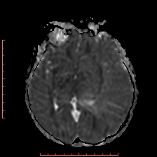 Astroblastoma (Radiopaedia 74287-85162 Axial ADC 28).jpg