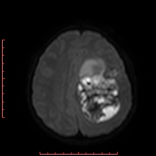 Astroblastoma (Radiopaedia 74287-85162 Axial DWI 71).jpg