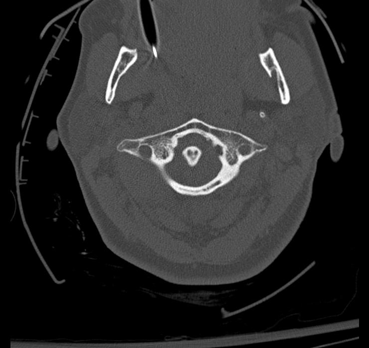 Atlanto-axial subluxation-dislocation (Radiopaedia 29659-30185 Axial bone window 22).jpg