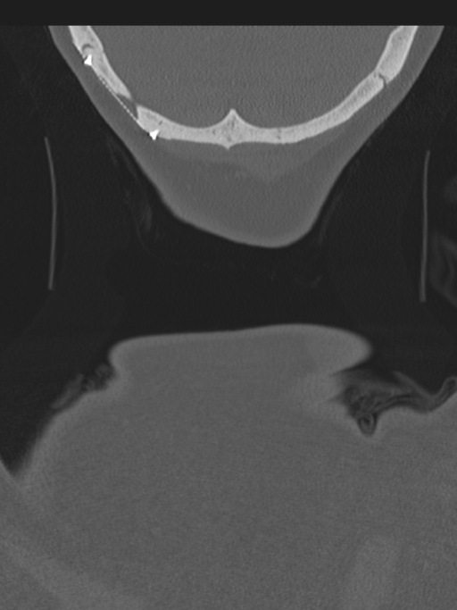 Atlanto-axial subluxation (Radiopaedia 36610-38176 Coronal bone window 65).png
