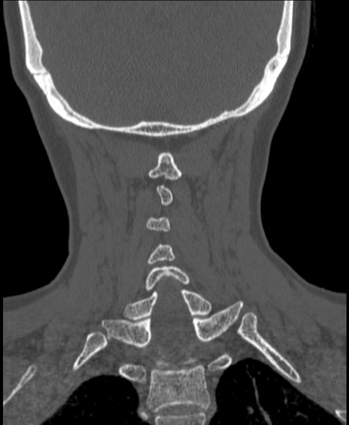 Atlanto-occipital assimilation with basilar invagination (Radiopaedia 70122-80188 Coronal bone window 176).jpg