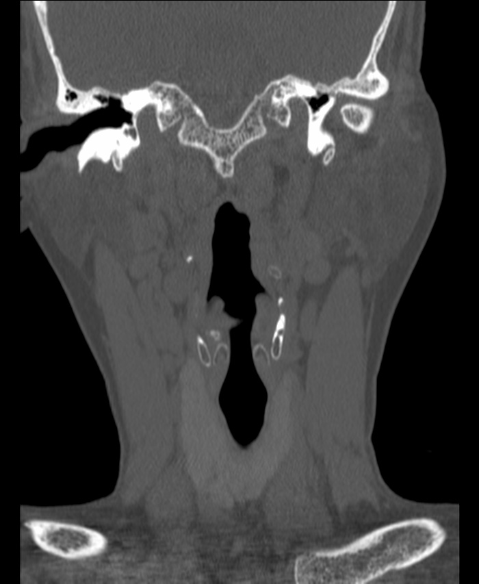 Atlanto-occipital assimilation with basilar invagination (Radiopaedia 70122-80188 Coronal bone window 30).jpg