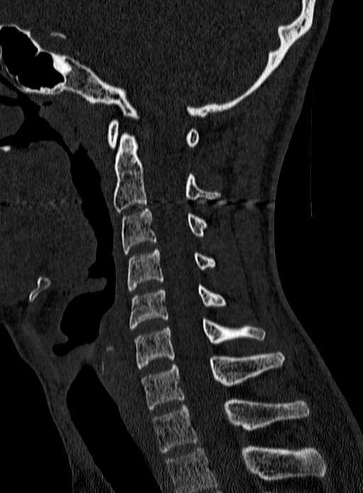 Atlantoaxial subluxation (Radiopaedia 44681-48450 Sagittal bone window 84).jpg