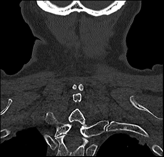 File:Atlas (type 3b subtype 1) and axis (Anderson and D'Alonzo type 3, Roy-Camille type 2) fractures (Radiopaedia 88043-104607 Coronal bone window 55).jpg