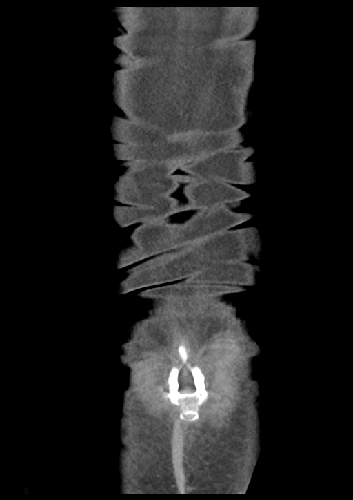 Atraumatic splenic rupture (Radiopaedia 42931-46160 B 56).png